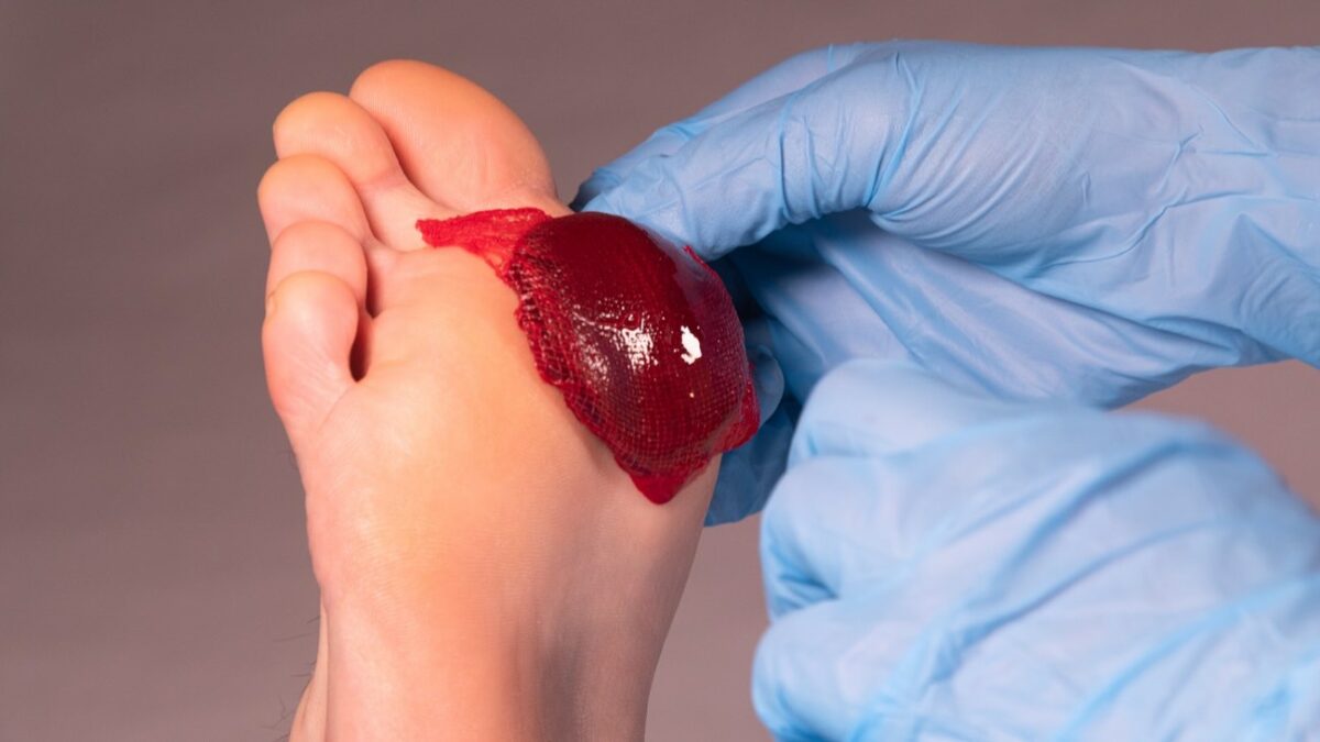 ActiGraft forms a blood clot outside the body, using the patient’s own blood, and is applied to trigger healing in a chronic wound. Photo courtesy of RedDress.