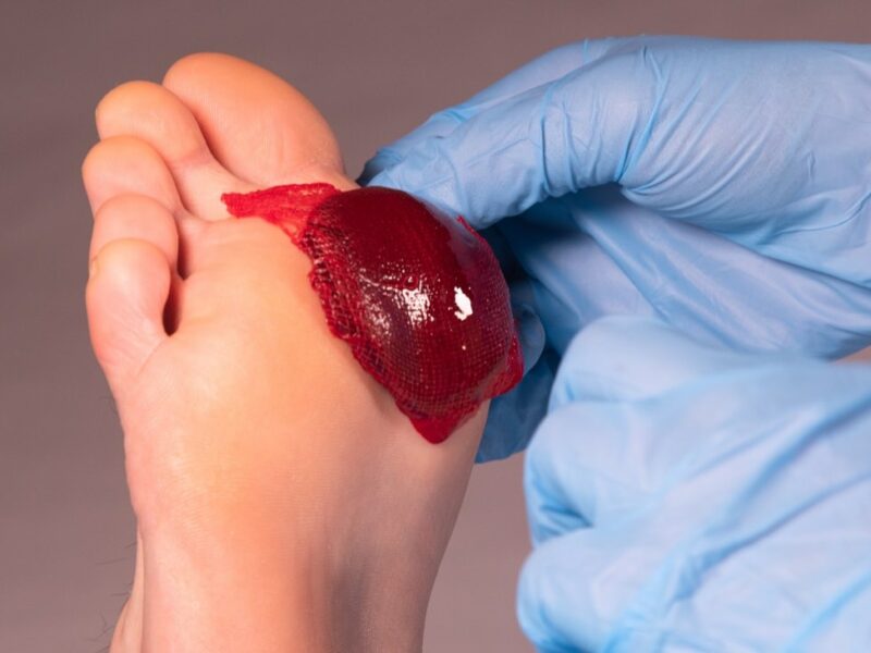 ActiGraft forms a blood clot outside the body, using the patient’s own blood, and is applied to trigger healing in a chronic wound. Photo courtesy of RedDress.